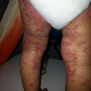 Atopic Dermatitis on legs