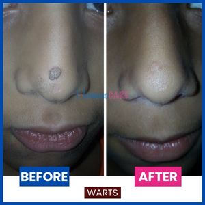 Before and after image of warts on nose. After image shows warts gone through homeopathic treatment for warts.