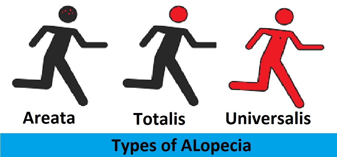 types of alopecia Homeopathic treatment of alopeciai