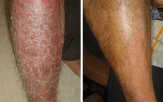 Before and After Psoriasis Treatment
