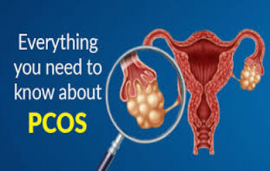 Successful Homeopathic treatment for PCOS