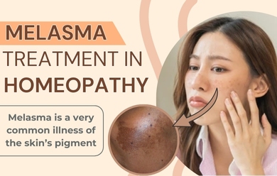 melasma homeopathy treatment