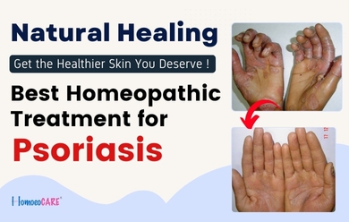 Blog On Homeopathic Treatment For Psoriasis