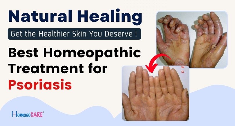 Homeopathic Treatment For Psoriasis