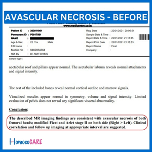 avascular necrosis