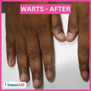 Successful homeopathic treatments for warts on hands and fingers.