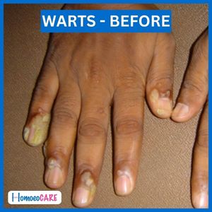 Warts on hand 