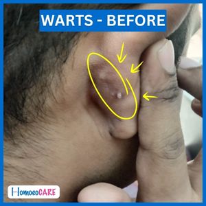 Warts On ears 