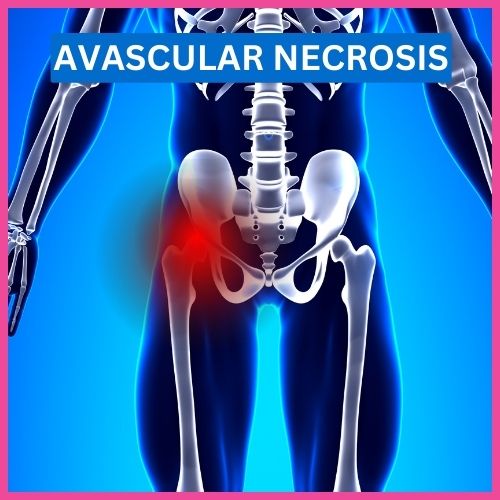 homeopathy treatment for avascular necrosis