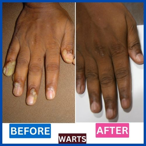 Case studies of successful homeopathic treatments for warts.