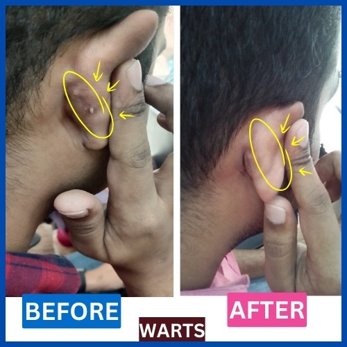 Homeopathic Warts Treatment | Before and After of Warts