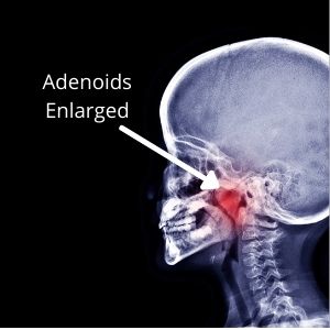 Conventional treatment for Adenoids