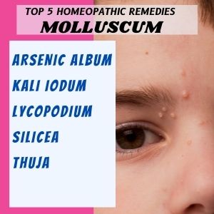 Top 5 Homeopathic medicines for Molluscum