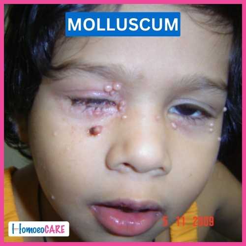 molluscum contagiosum eyelid