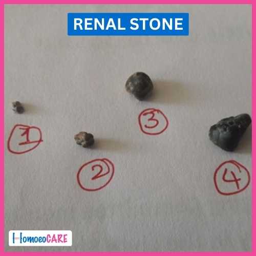 Succesful Homeopathic Treatment of kidney stone.jpg
