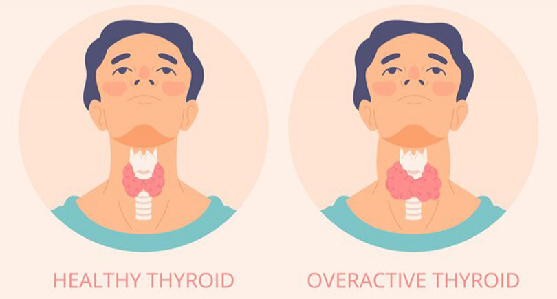 Weight-Loss-and-Hypothyroidism