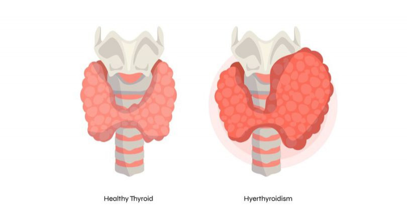 hypothytriodism