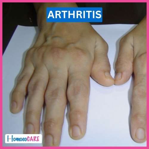 Arthritis