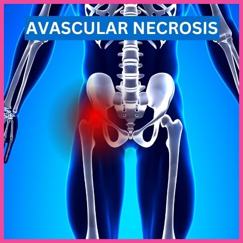 Avascular_necrosis