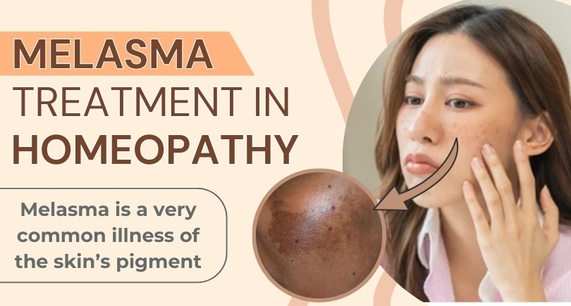 Melasma_Treatment_in_Homeopathy