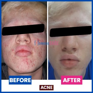 Acne_Rosacea