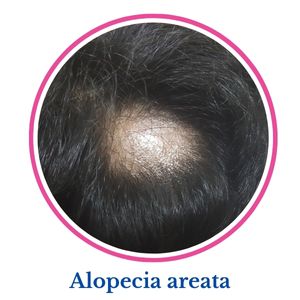 Alopecia Areata