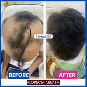 Alopecia Areata(1)