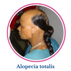 Alopecia Totalis