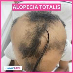 Alopecia Totalis(1)