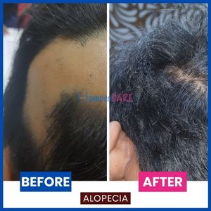 AlopeciaAreatascalp(2)