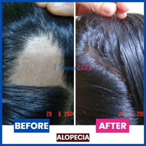 Alopecia_Areata