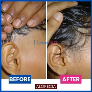 Alopecia_Areata_scalp