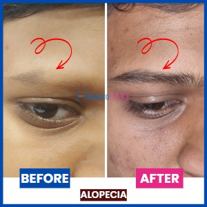 Alopecia_on_eyebrows