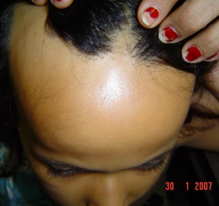 Alopeciascalphomeopathictreatment