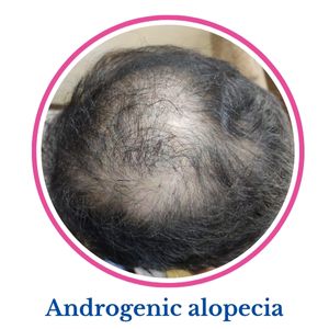 Androgenic alopecia