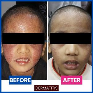 .Atopic_dermatitis