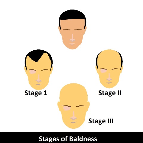 Baldness_stages_homeopathic_treatment_alopecia