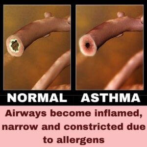 Cause of Asthma