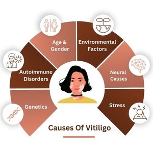 Causes of vitiligo(2)