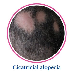 Cicatricial Alopecia