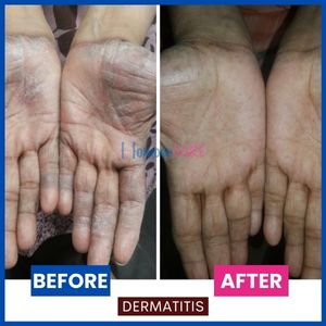 Contact_Dermatitis