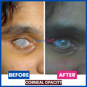 Corneal_Opacity