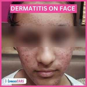 Dermatitis On Face