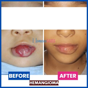 Hemangioma