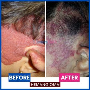 Hemangioma_1