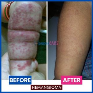 Hemangioma_Hands