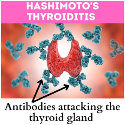 Homeopathic_treatment_for_Hashimotos_Thyroiditis