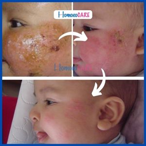 Homoeocare Atopic Dermatitis