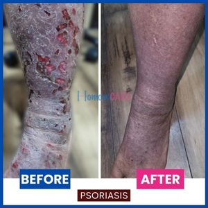 Homoeocare Infected_Psoriasis