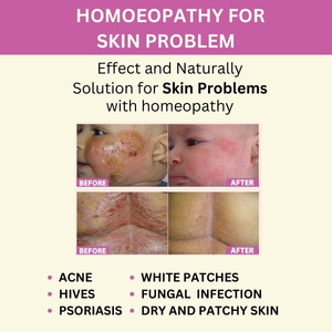 Homoepathy For Skin problem